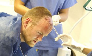 Wayne Rooney hair transplant procedure