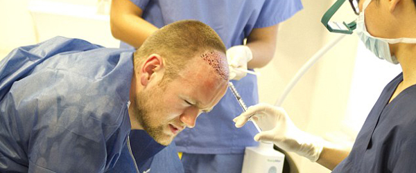 Wayne Rooney hair transplant procedure